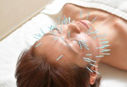 Acupuncture Esthétique